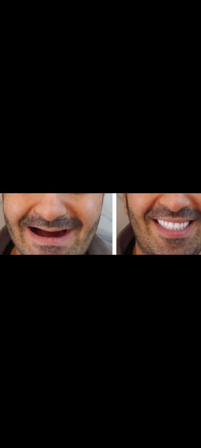 دندانسازی باکیفیت عالی، قیمت مناسب خیابان گرگان|خدمات آرایشگری و زیبایی|تهران, گرگان|دیوار