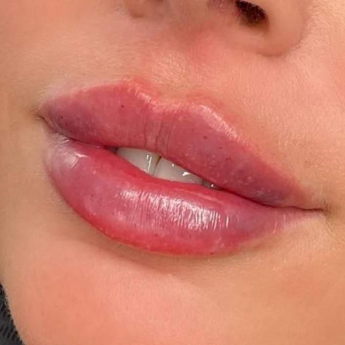 تزریق ژل بوتاکس لیزر هایفو مزو پی ار پی نخ فیشیال|خدمات آرایشگری و زیبایی|شهریار, |دیوار