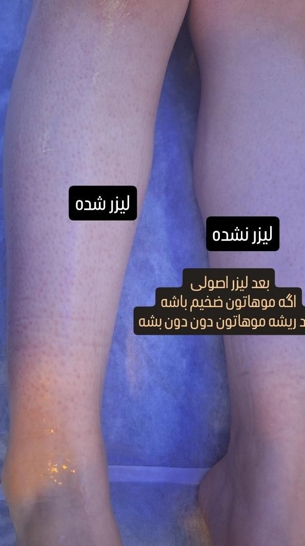 لیزرموی زائد دررودکی فقط بانوان نظارت پزشک ۴۸۰تومن|خدمات آرایشگری و زیبایی|ارومیه, |دیوار