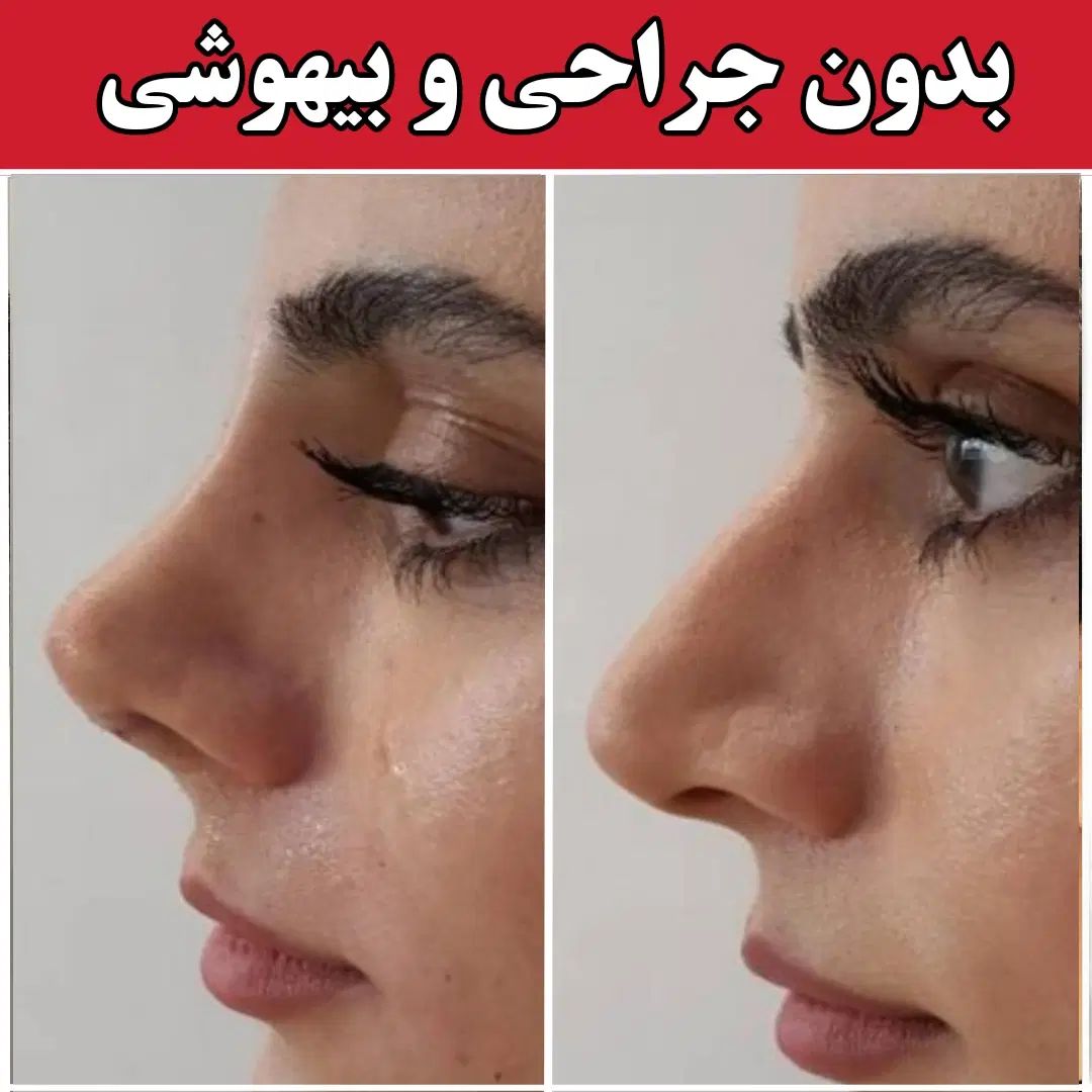 آف فرمدهی بینی بدون عمل جراحی پزشک پوست مو زیبایی|خدمات آرایشگری و زیبایی|مشهد, هفت تیر (آب و برق)|دیوار