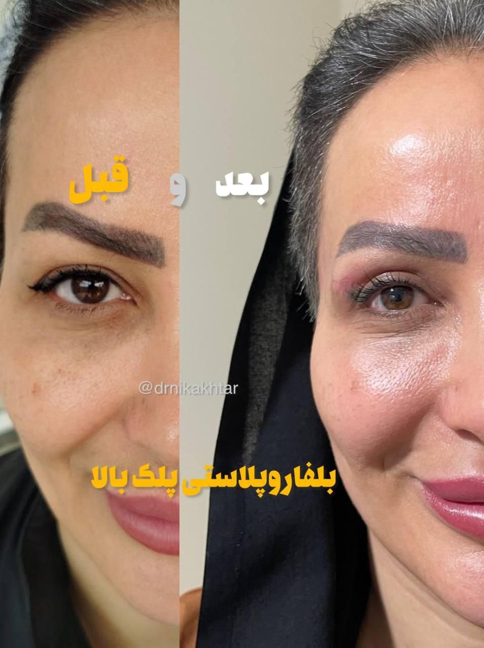حذف پف پلک و افتادگی بوتاکس،ژل،بوکال،سانترال،هایفو|خدمات آرایشگری و زیبایی|تبریز, |دیوار