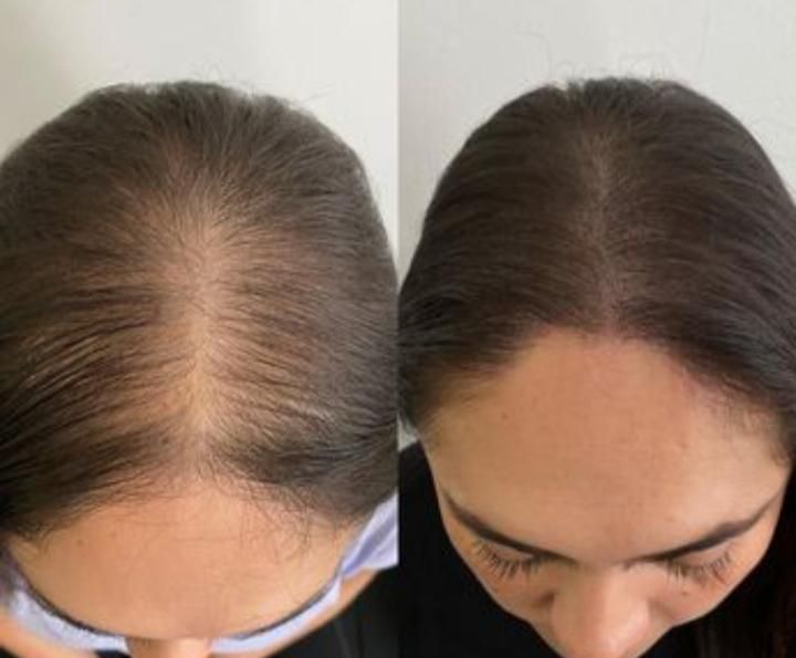 PRP/prpمو/prpصورت/درمان ریزش مو/درمان لک|خدمات آرایشگری و زیبایی|اصفهان, عباس‌آباد|دیوار