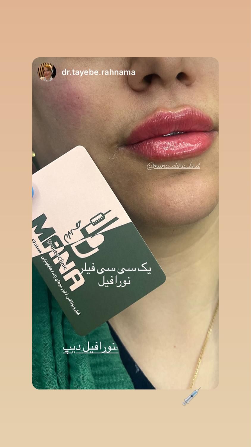 فرصت طلایی برای تزریق ژل و انواع فیلر بوتاکس|خدمات آرایشگری و زیبایی|بندرعباس, |دیوار