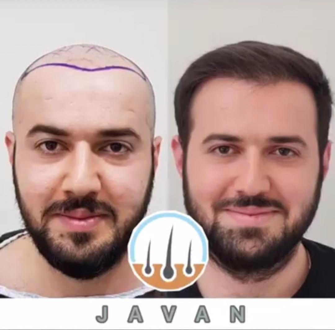 کاشت مو ابرو بلفاروپلاستی مزو تراپی پی آرپی|خدمات آرایشگری و زیبایی|تهران, صادقیه|دیوار