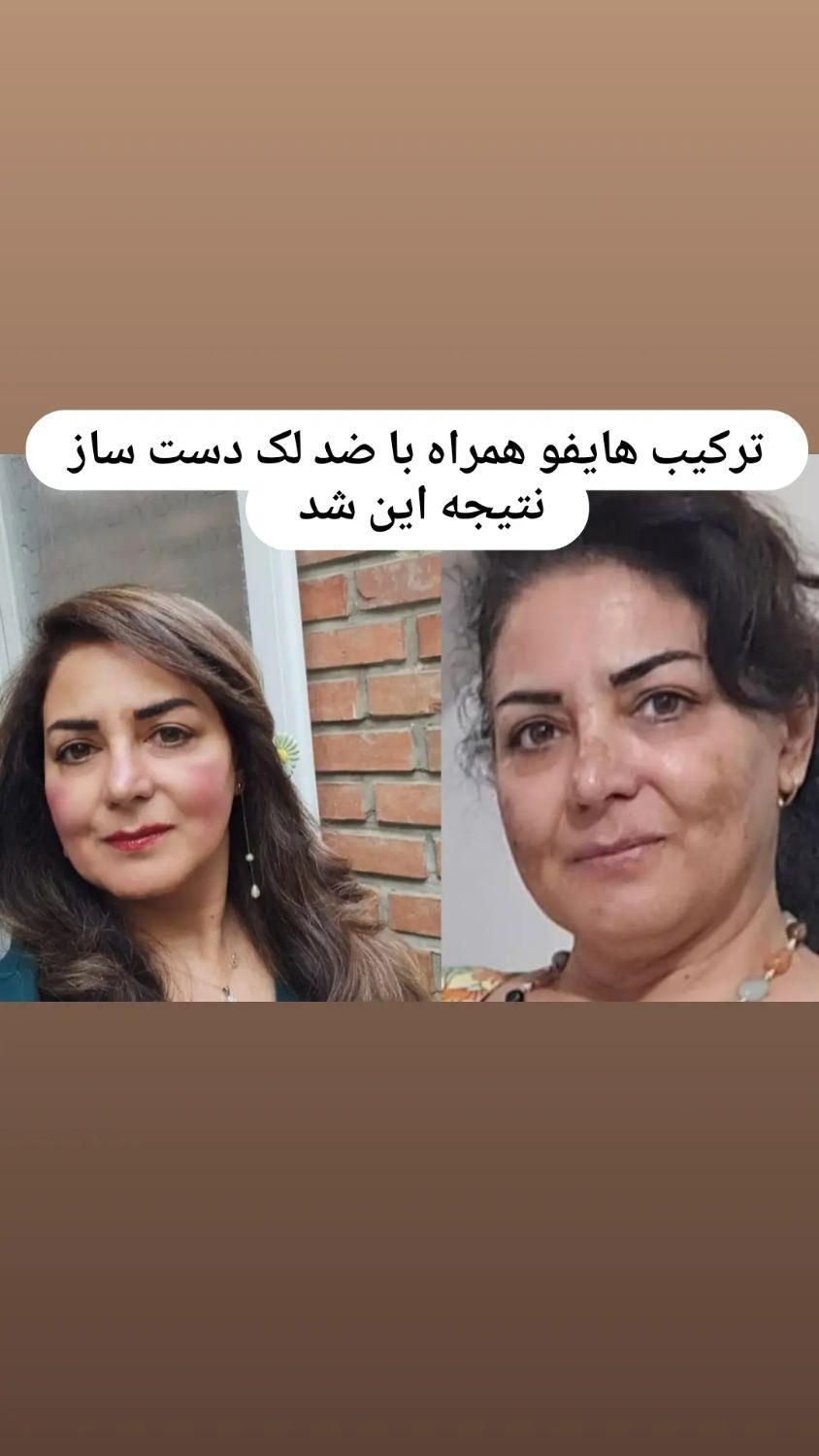 لیزرموزائد سوپرانوتیتانیوم آلما اصلی ۴۹۰تومن|خدمات آرایشگری و زیبایی|گرگان, |دیوار