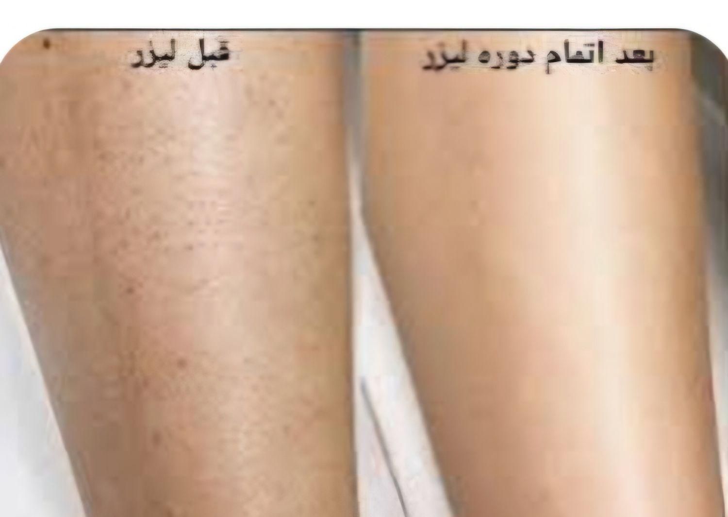 لیزر ژل بوتاکس موژان|خدمات آرایشگری و زیبایی|تهران, خزانه|دیوار