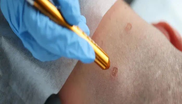 درمان زگیل تناسلی با لیزر / کلینیک تهرانی|خدمات آرایشگری و زیبایی|تهران, ونک|دیوار
