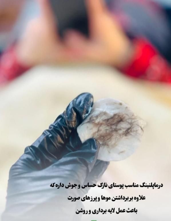 دستگاه فشیال درما پلنینگ . پاکسازی و آبرسانی|آرایشی، بهداشتی، درمانی|زابل, |دیوار
