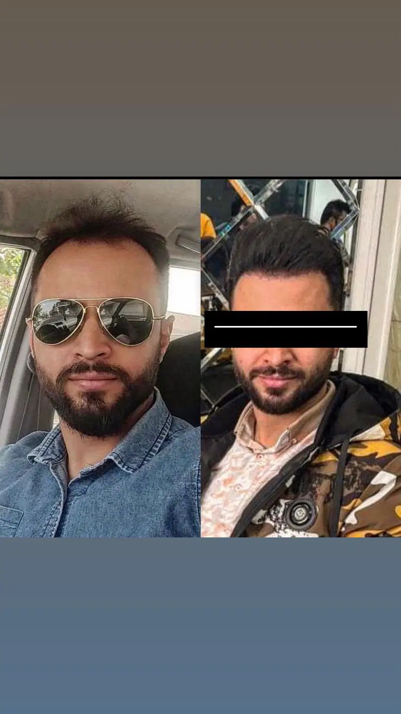 استخدام ویزیتور با پورسانت بالا در حوزه کاشت مو|استخدام بازاریابی و فروش|تهران, سعادت‌آباد|دیوار