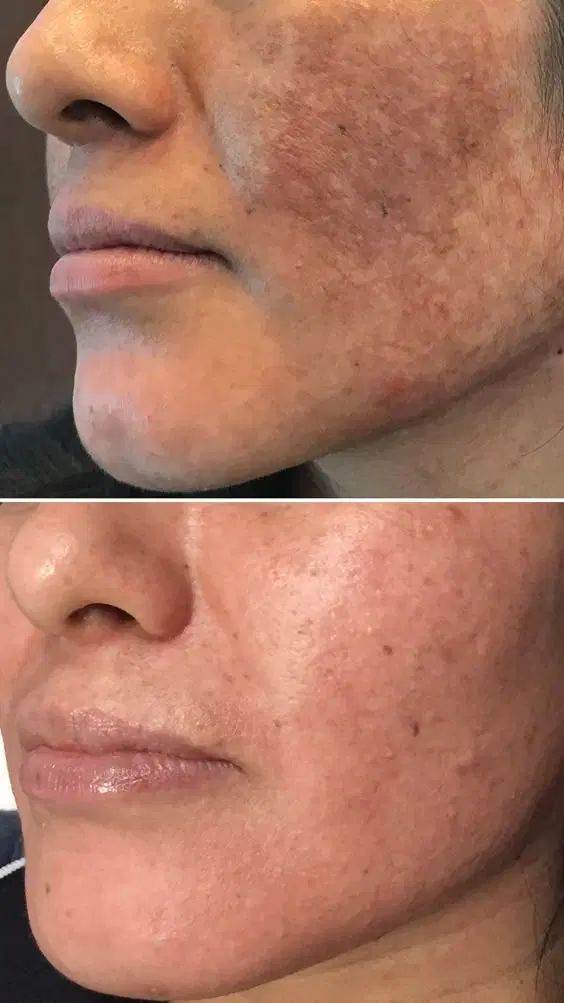 دوره تخصصی آموزش مزوژل و جوانسازی پوست و پاکسازی|خدمات آموزشی|تهران, چیتگر جنوبی|دیوار