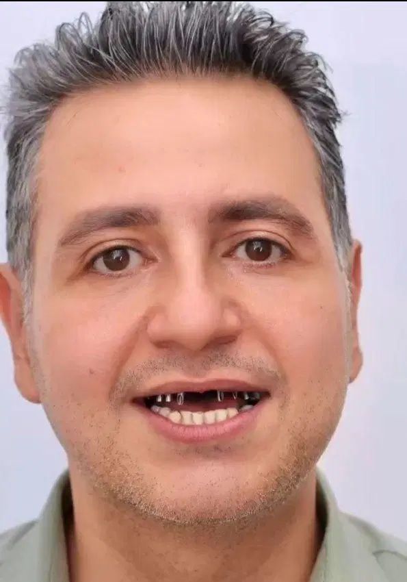 دندانپزشکی ایمپلنت کامپوزیت روکش لمینت‌ ارتودنسی|خدمات آرایشگری و زیبایی|تبریز, |دیوار