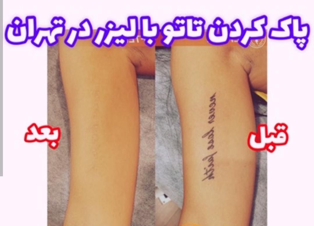 رفع تاتوروشن‌سازی زیربغل کربن تراپی مطب دکترموسوی|خدمات آرایشگری و زیبایی|تهران, فردوس|دیوار