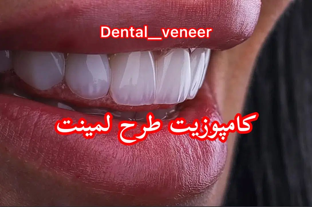 کامپوزیت دندان رایگان  ،لمینت ( اقساط ۱۵ ماه)|خدمات آرایشگری و زیبایی|تهران, الهیه|دیوار