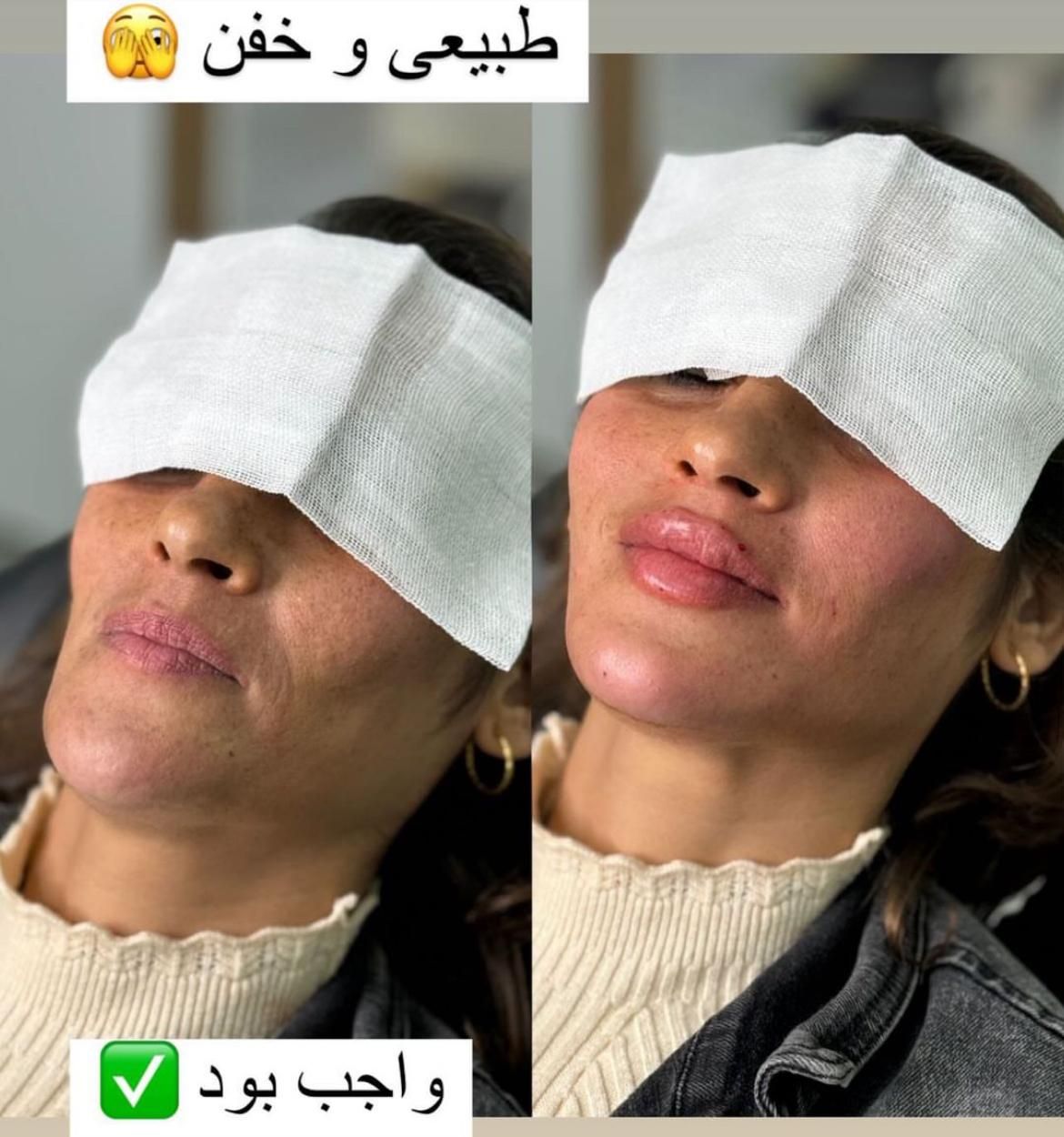 ژل و فیلر صورت و بدن|خدمات آرایشگری و زیبایی|اصفهان, ملک|دیوار
