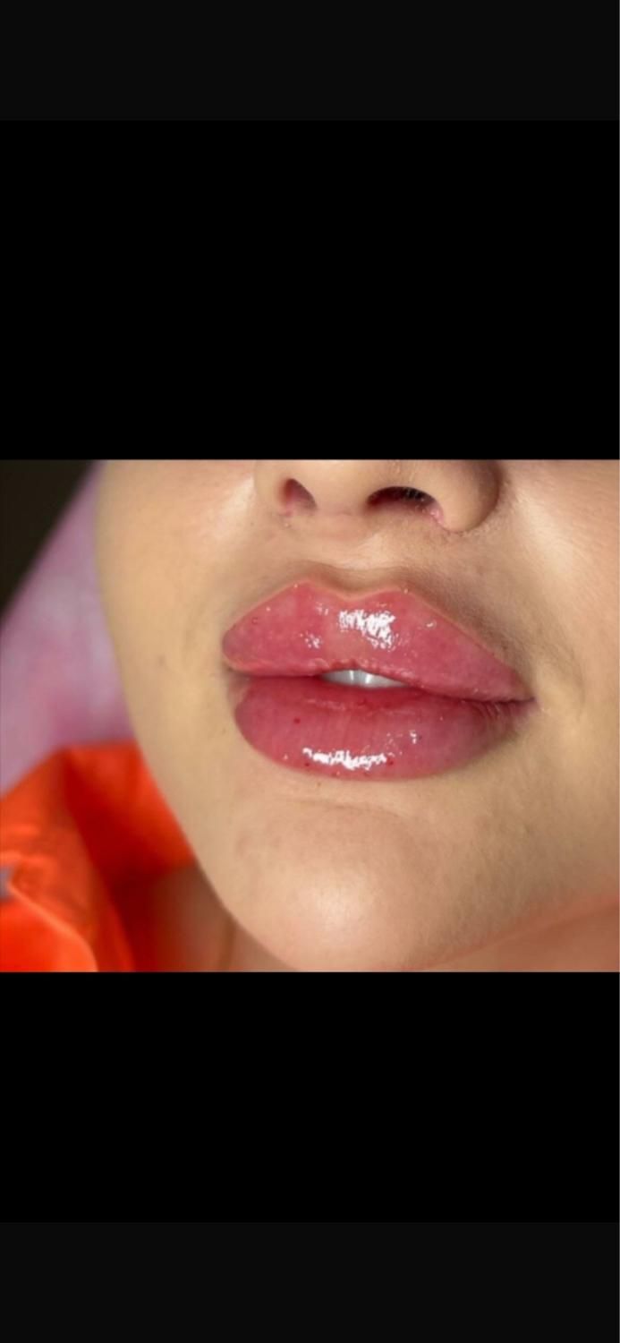 جشنواره تابستانه تزریق ژل و بوتاکس|خدمات آرایشگری و زیبایی|کرج, خرمدشت|دیوار