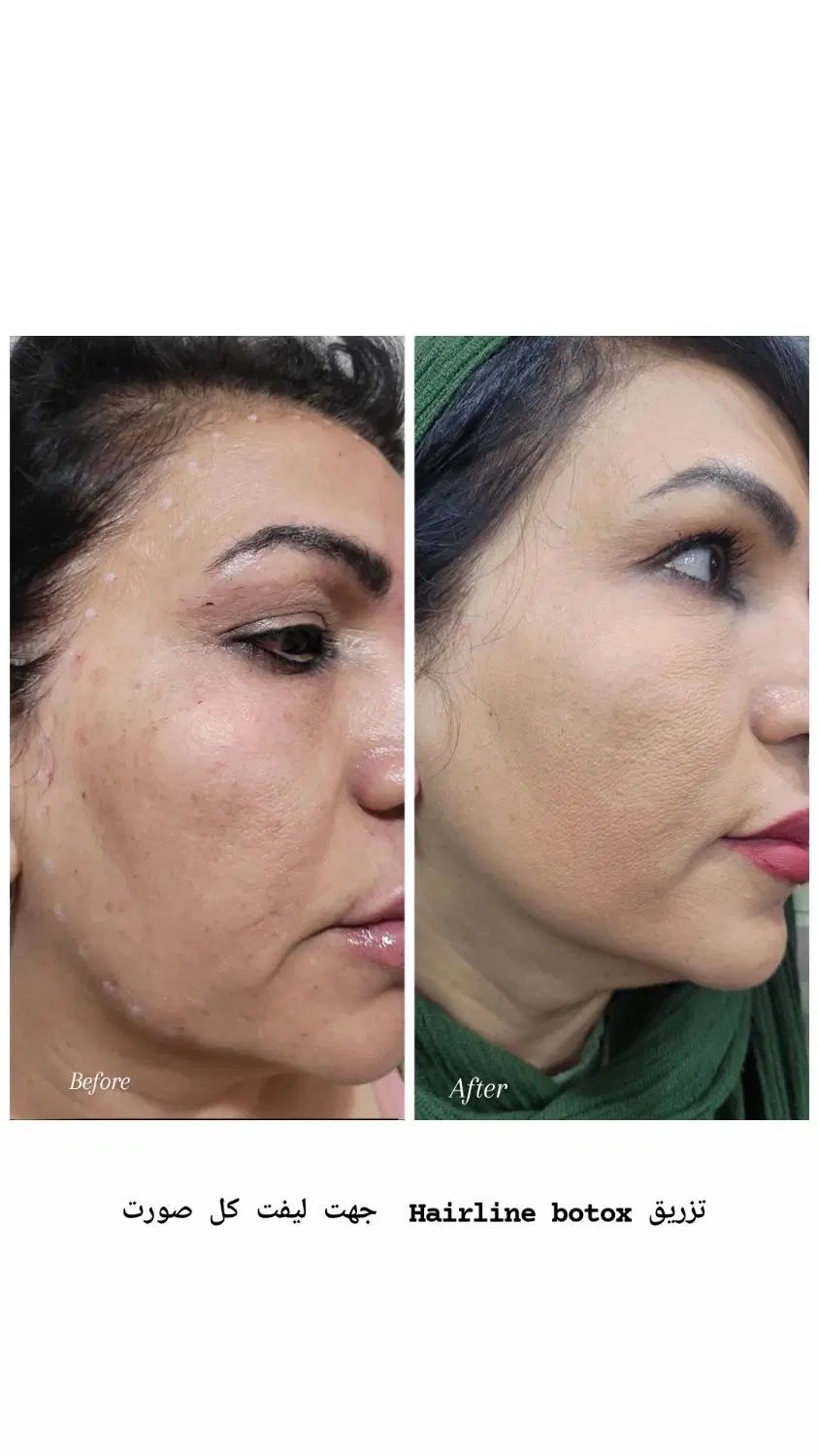 خدمات و آموزش تخصصی ژل و بوتاکس|خدمات آرایشگری و زیبایی|کرج, کیانمهر|دیوار