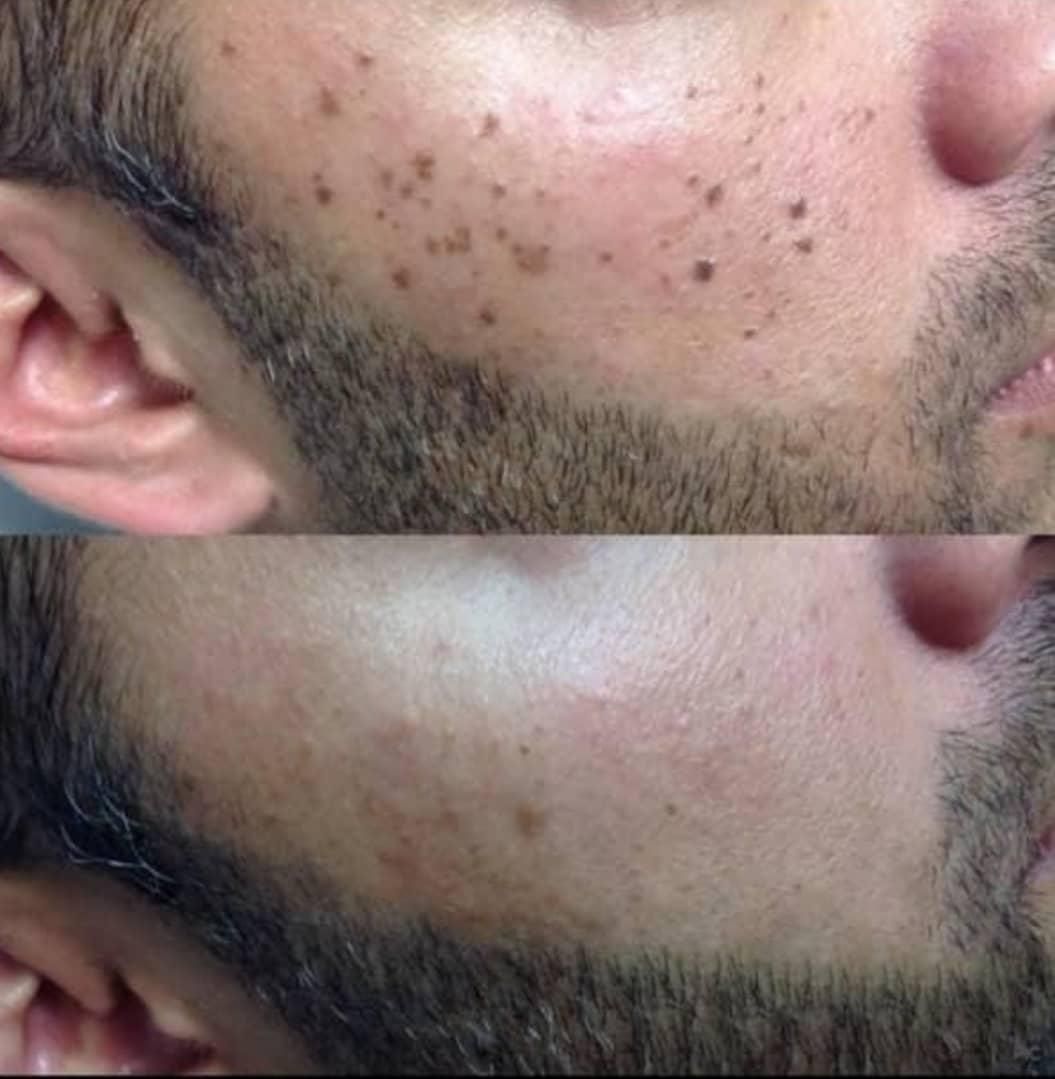 رفع انواع خال کک مک لک بادستگاه پیشرفته|خدمات آرایشگری و زیبایی|یاسوج, |دیوار