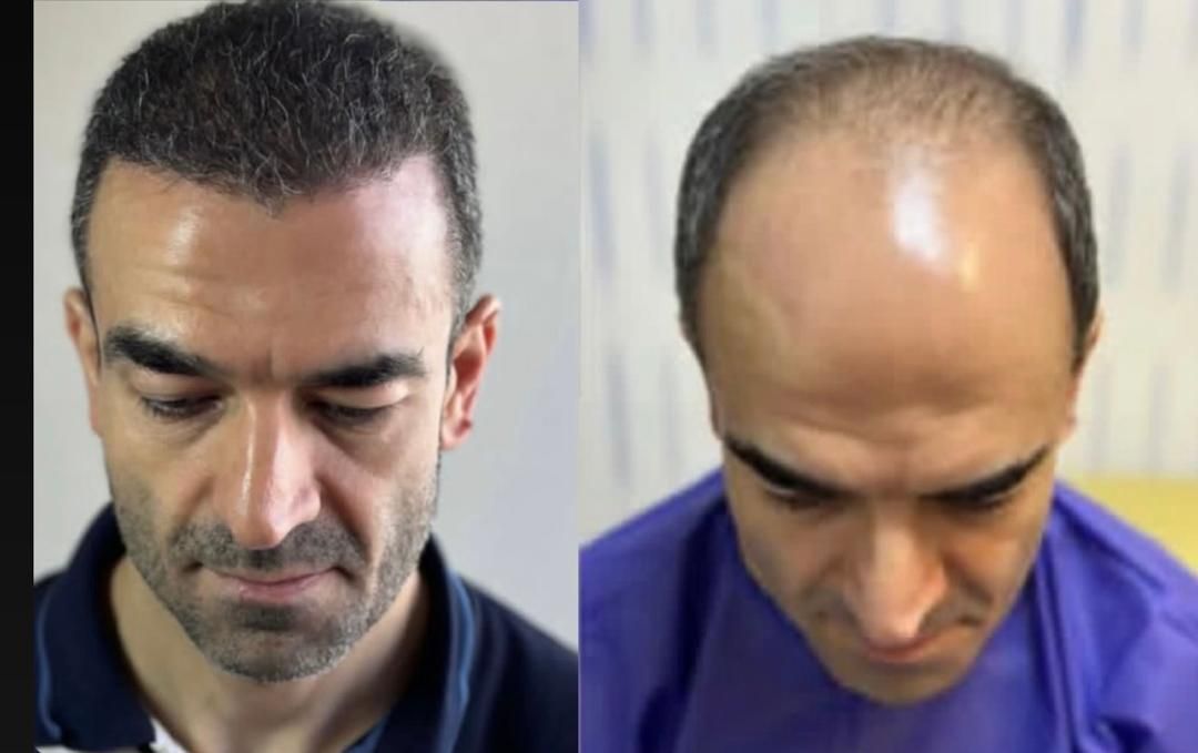 کاشت مو با ضمانت کتبی|خدمات آرایشگری و زیبایی|تهران, باغ فردوس|دیوار