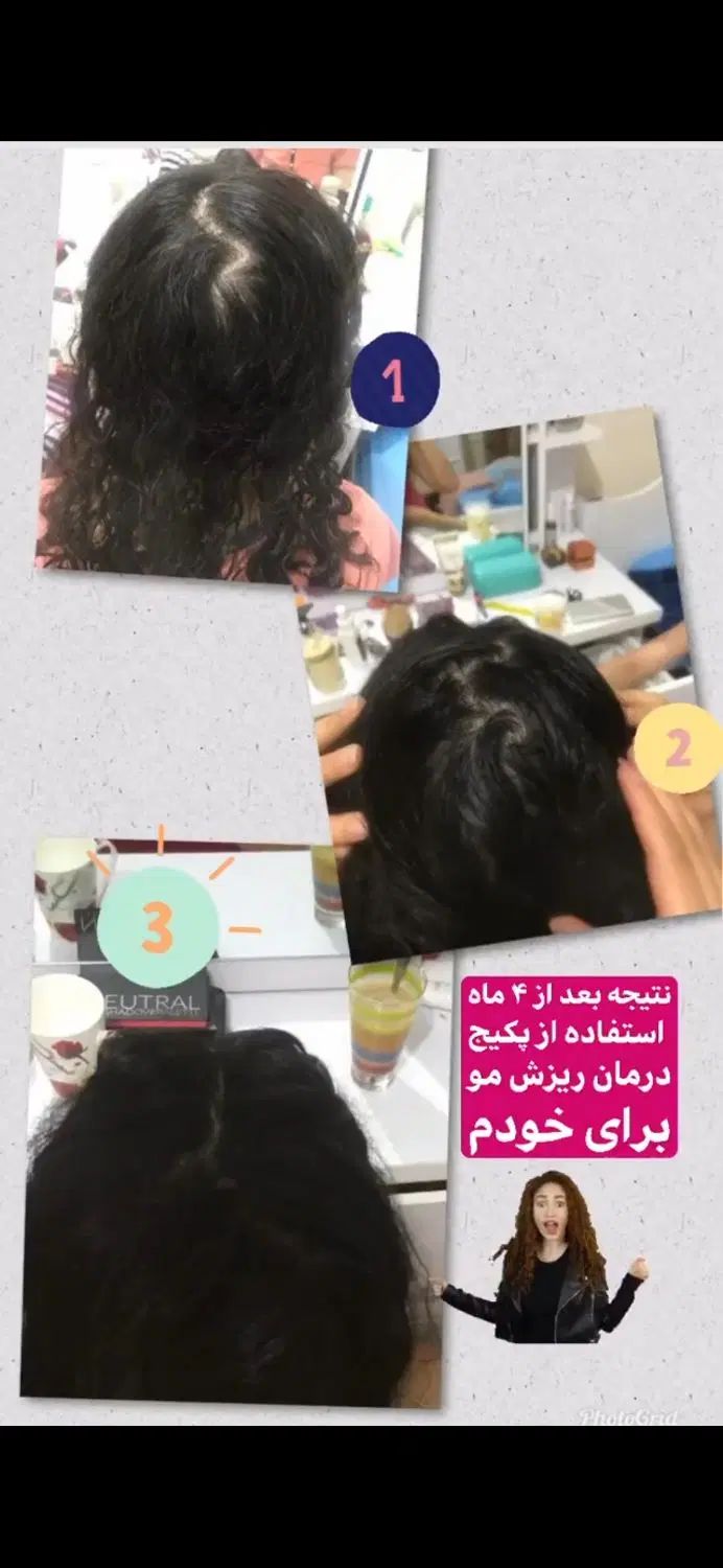 قطع ریزش مو فقط در یک ماه کاملا تضمینی|آرایشی، بهداشتی، درمانی|مشهد, استاد یوسفی (شهرک غرب)|دیوار