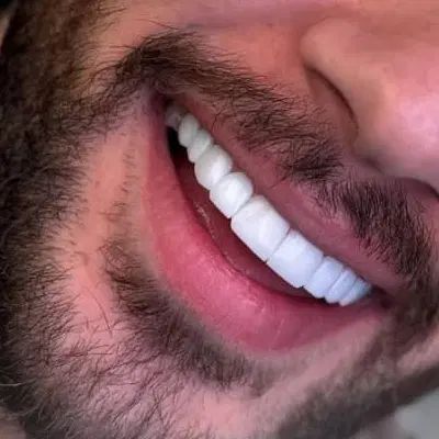 کامپوزیت دندان/اقساط/آف ویژه|خدمات آرایشگری و زیبایی|اصفهان, جلفا|دیوار