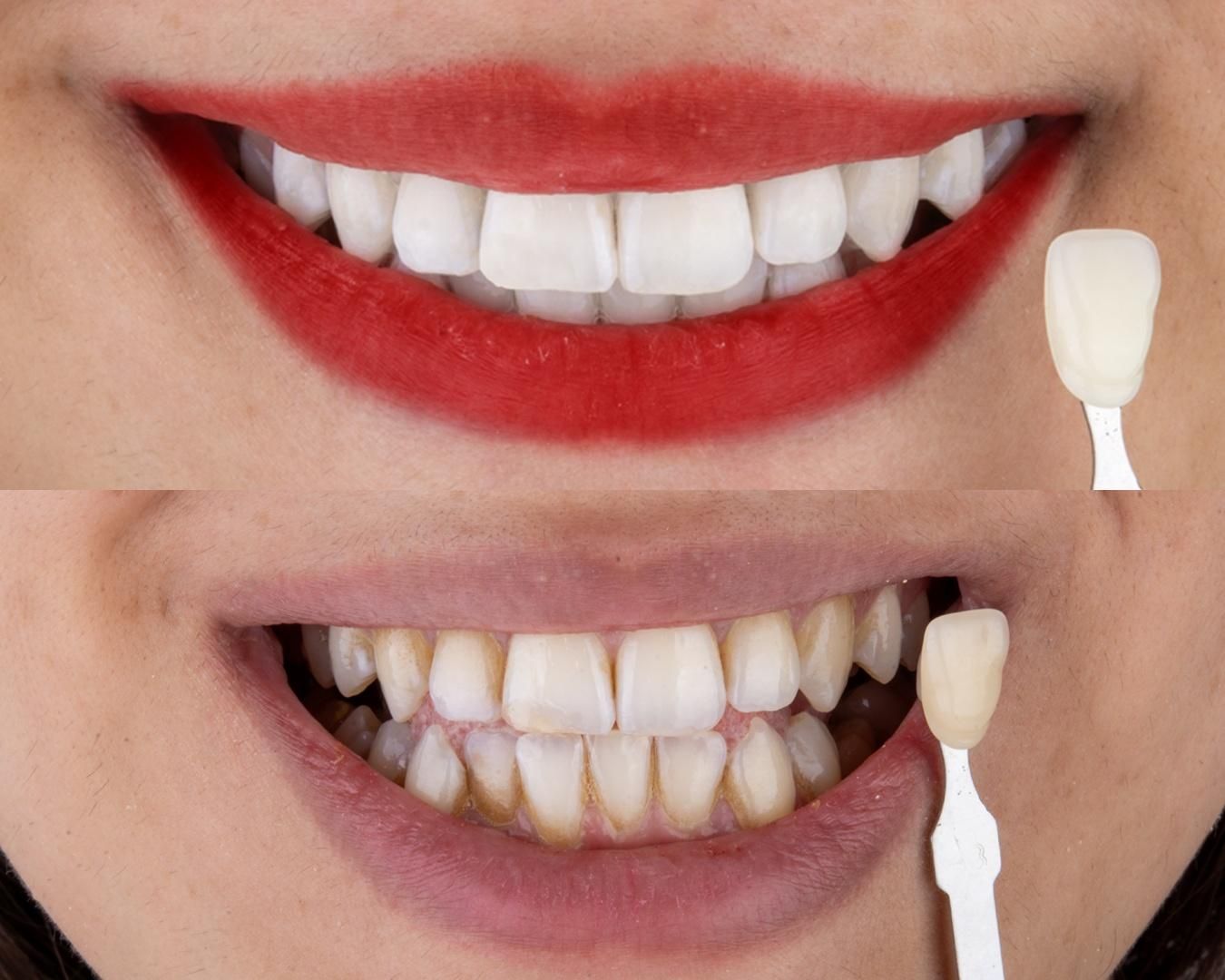 سفید کردن دندان (بلیچینگ)|خدمات آرایشگری و زیبایی|فولادشهر, B2|دیوار