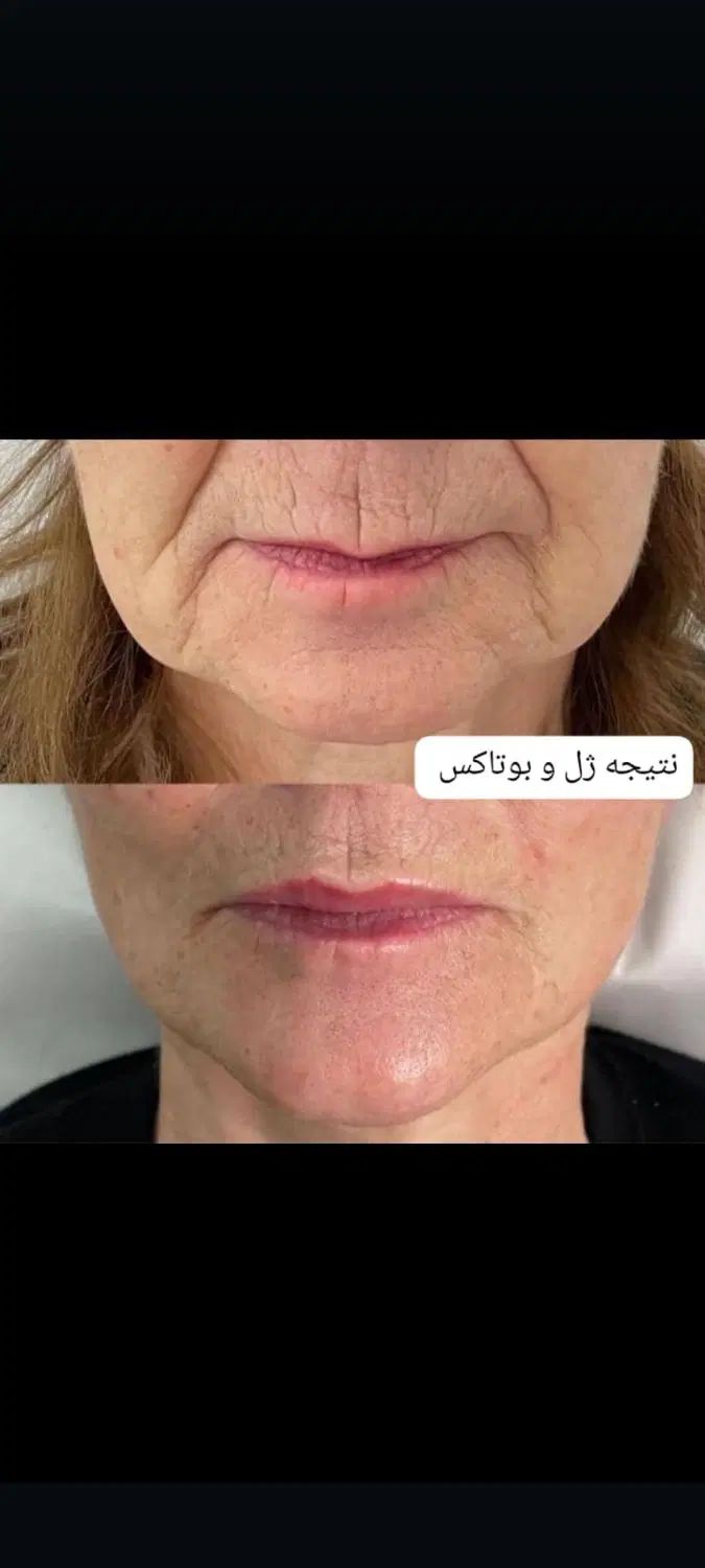 فیلر بوتاکس لیزر فیلربادی لاغری مزوتراپی prp جراحی|خدمات آرایشگری و زیبایی|مشهد, هنرستان|دیوار