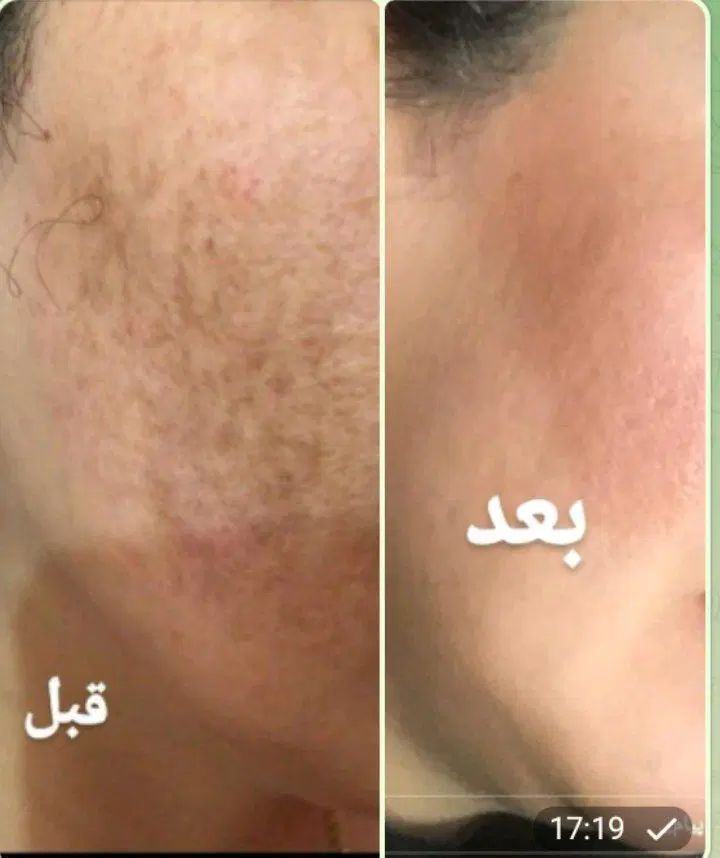 حذف ۶ روزه کک مک|آرایشی، بهداشتی، درمانی|اصفهان, رسالت|دیوار