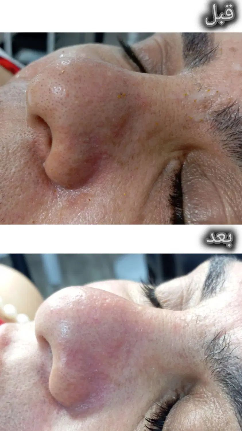 مدل برای روشن سازی صورت و از بین بردن جوش|خدمات آرایشگری و زیبایی|مسجد سلیمان, |دیوار