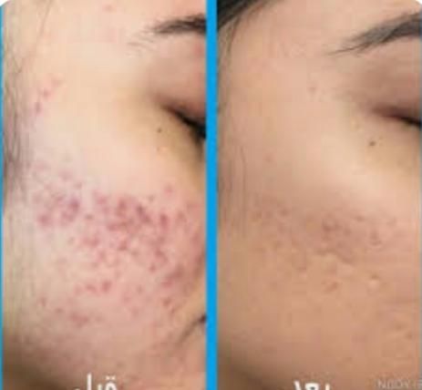 پاکسازی پوست|خدمات آرایشگری و زیبایی|بندر انزلی, گمرک|دیوار
