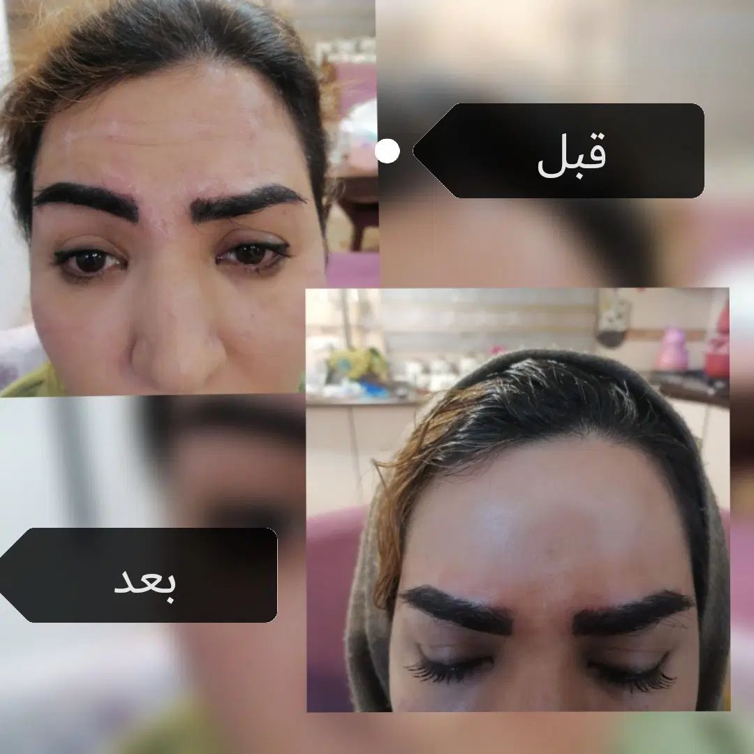 بوتاکس. فیلر. مزوتراپی. فشیال|خدمات آرایشگری و زیبایی|تهران, زاهد گیلانی|دیوار