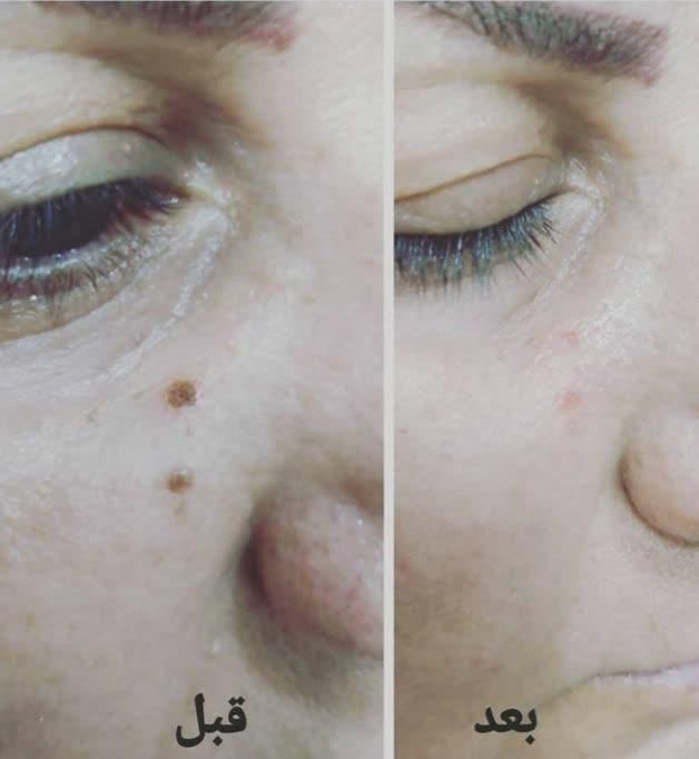 رفع انواع خال کک مک لک بادستگاه پیشرفته|خدمات آرایشگری و زیبایی|یاسوج, |دیوار