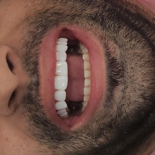 کامپوزیت ایمپلنت ارتودنسی بندرعباس|خدمات آرایشگری و زیبایی|بندرعباس, |دیوار