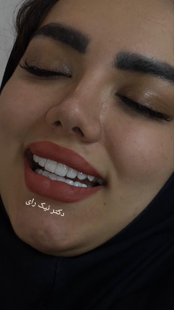 کامپوزیت زیبایی دندان|خدمات آرایشگری و زیبایی|صحنه, |دیوار