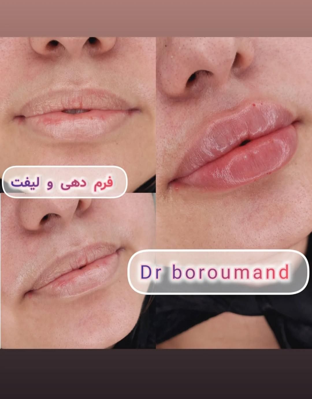 فیلر/ ژل لب تخصصی ۱.۳۰۰ ، بوتاکس پیشانی / لیفت۷۶۰|خدمات آرایشگری و زیبایی|مشهد, هدایت|دیوار