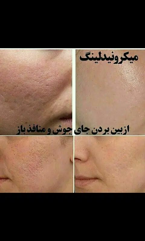 جشنواره تخفیف ویژه تابستانی  پاکسازی تخصص پوست|خدمات آرایشگری و زیبایی|نوشهر, |دیوار