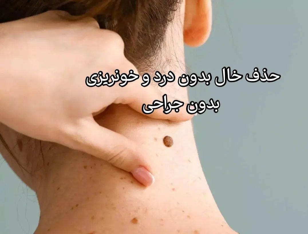 حذف فوری خال منگوله ای|آرایشی، بهداشتی، درمانی|رشت, علی آباد|دیوار