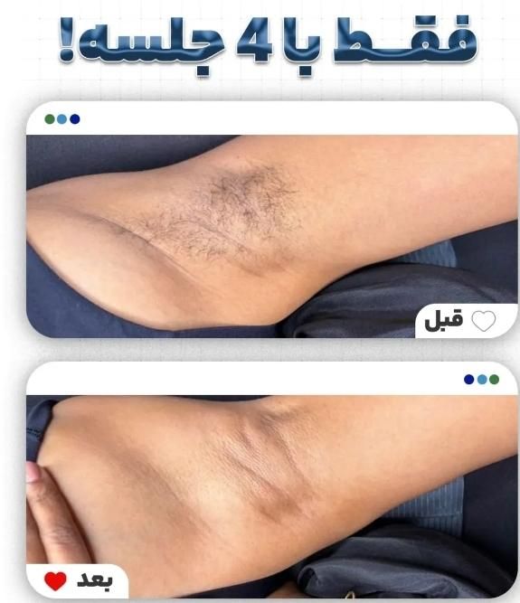 لیزر موج کندلا لیزر بانوان  لیزر آقایان لیزر خانم|خدمات آرایشگری و زیبایی|اصفهان, باغ زرشک|دیوار