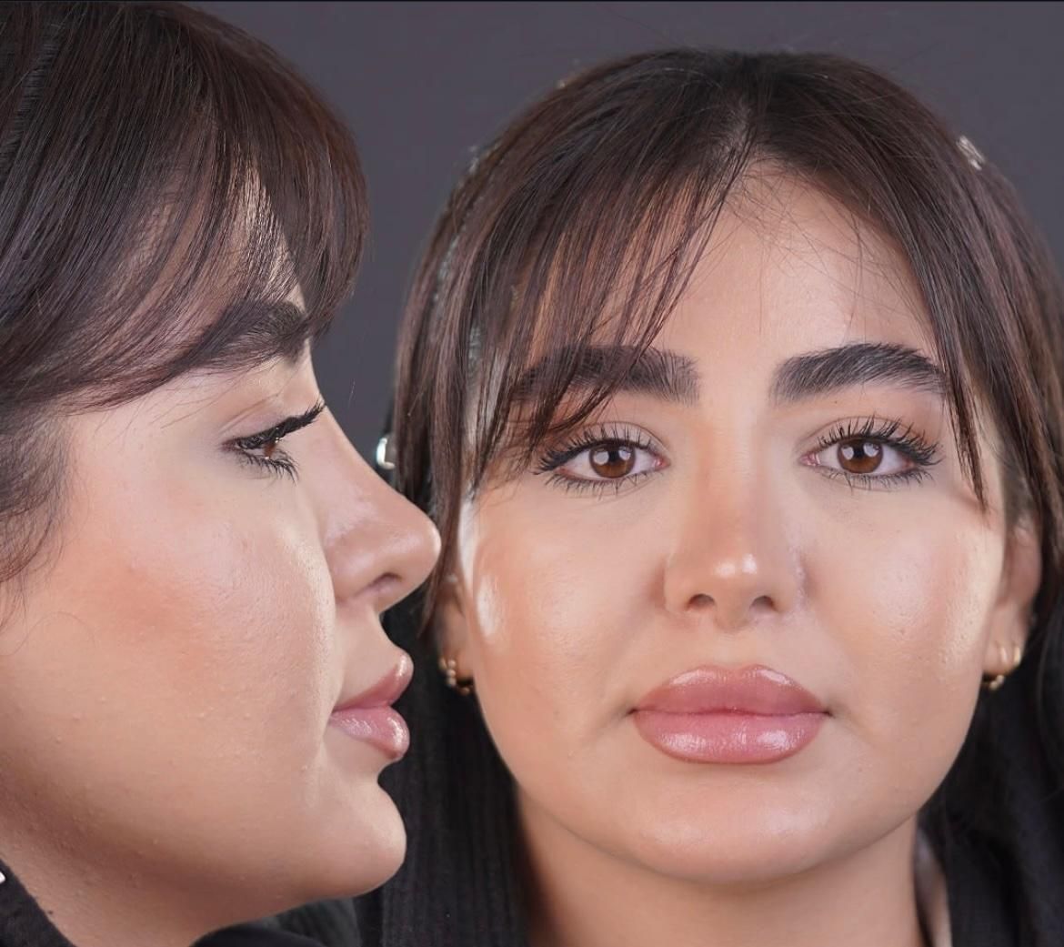 کامپوزیت لمینت ایمپلنت جراحی بینی بلفارو ساکشن|خدمات آرایشگری و زیبایی|مشهد, سجاد شهر|دیوار