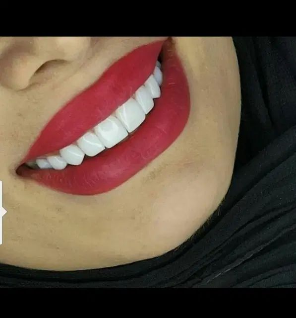 زیبایی لبخند با نازلترین قیمت و شرایط اقساطی|آرایشی، بهداشتی، درمانی|تبریز, |دیوار