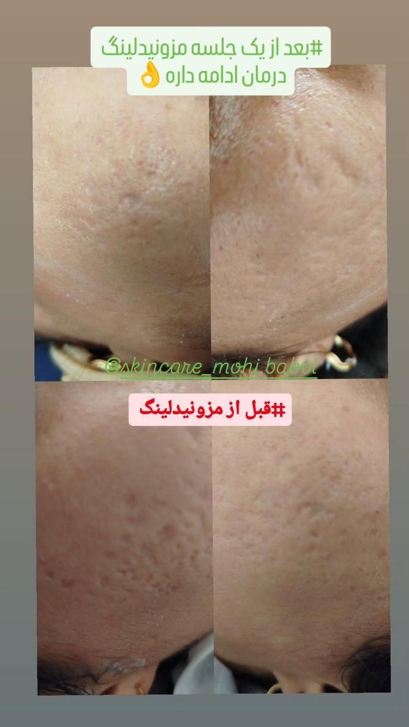 آموزش تخصصی کارهای پوستی با پنجاه درصد تخفیف|خدمات آموزشی|بابل, |دیوار