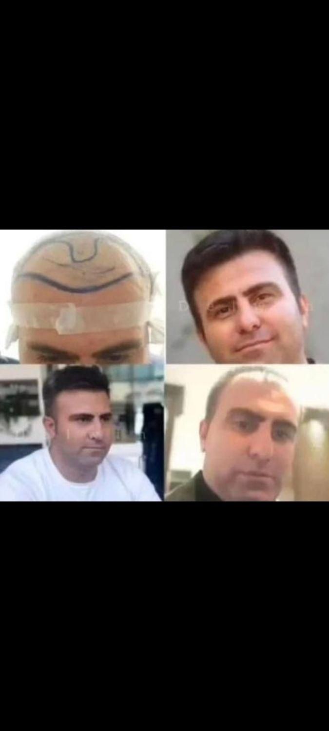 کاشت مو وابروی تخصصی فقط با ۱۳ میلیون تومان|خدمات آرایشگری و زیبایی|تهران, نیلوفر|دیوار