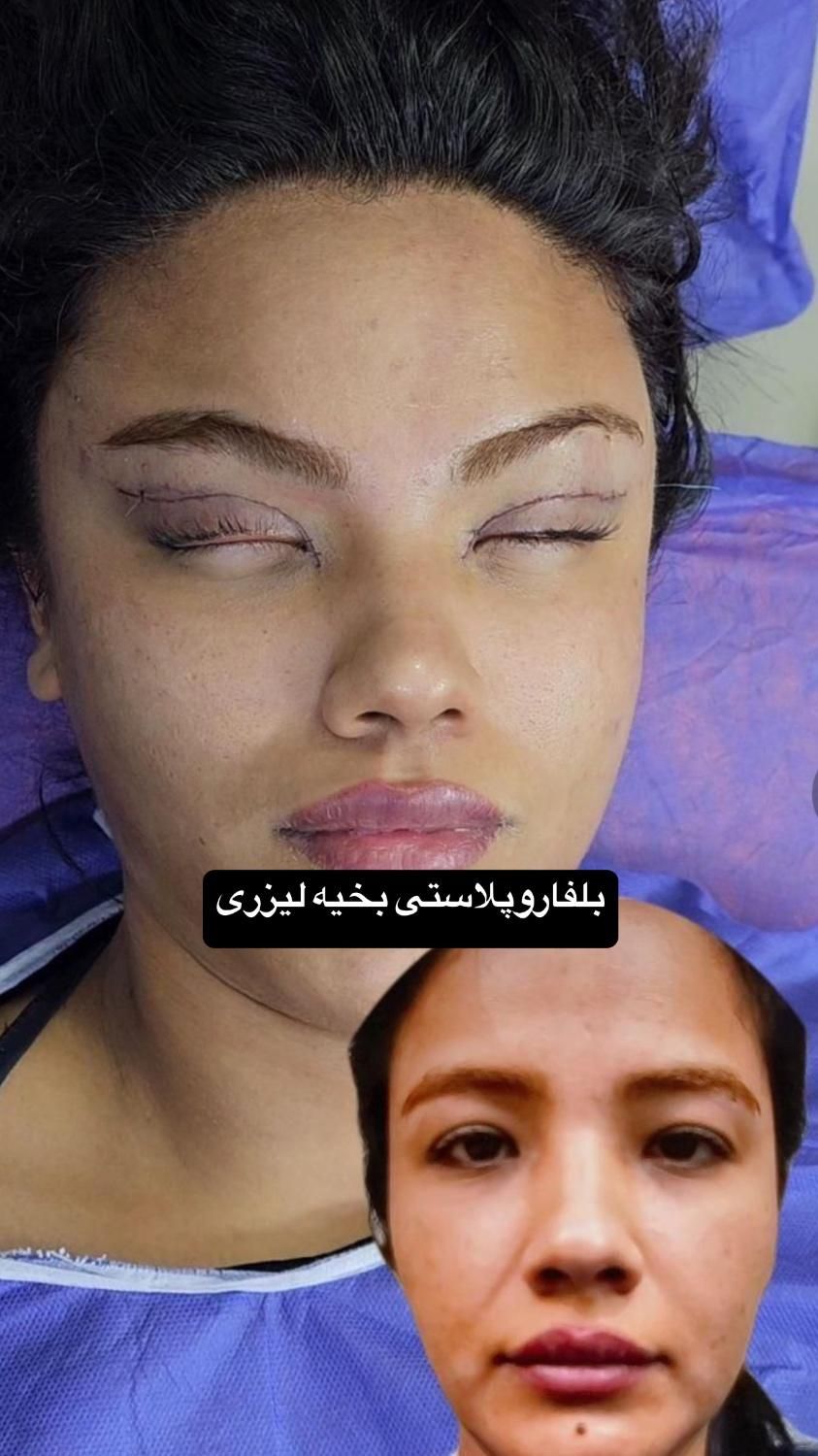 افتادگی پلک،بلفاروپلاستی،سانترال لب،بوکال فت،غبغب|خدمات آرایشگری و زیبایی|تهران, پاسداران|دیوار