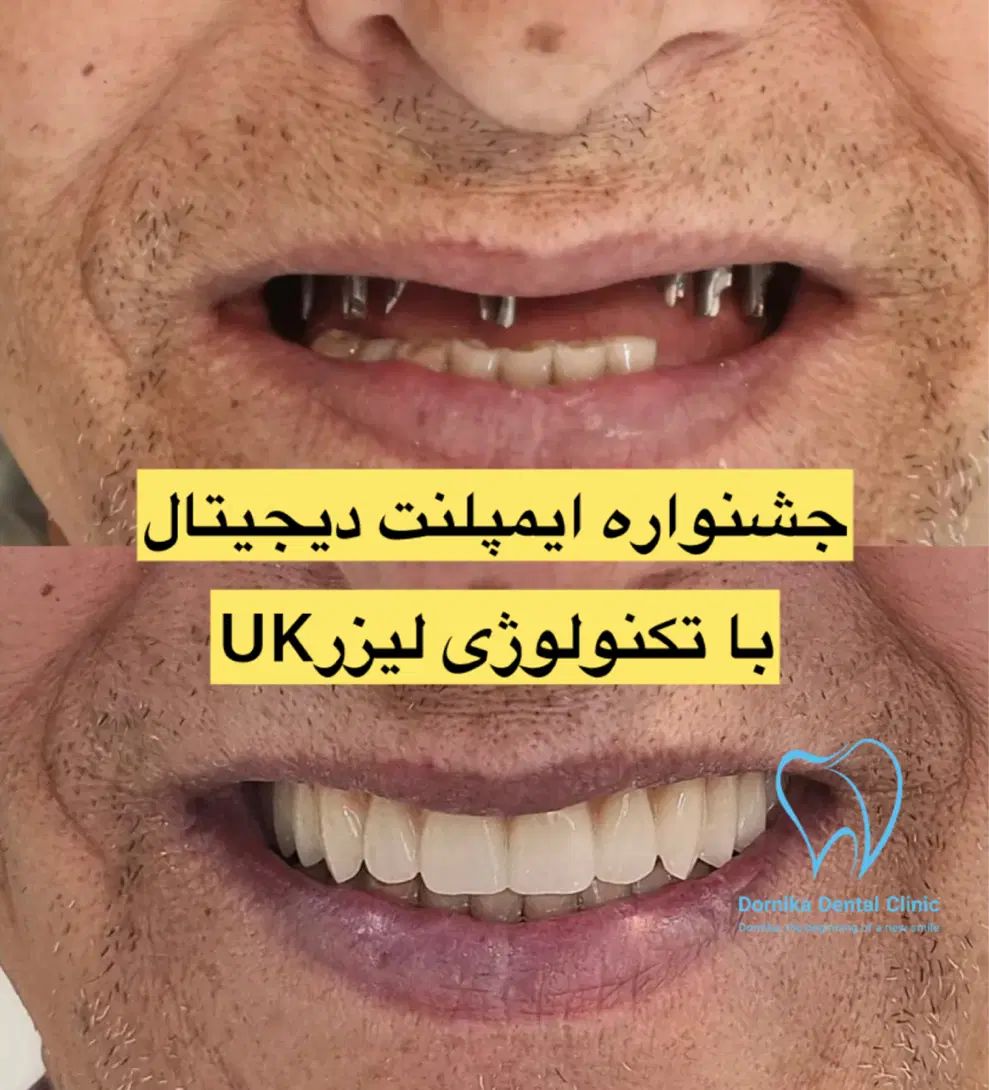 هر۴واحد ایمپلنت دیجیتال+1ایمپلنت رایگان/کاشت دندان|خدمات آرایشگری و زیبایی|تهران, فرمانیه|دیوار