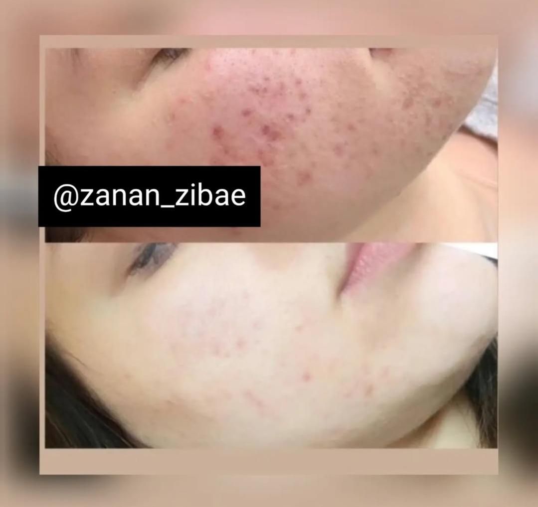 مزوتراپی مو و صورت و هیرفیلر (جشنواره)درمطب|خدمات آرایشگری و زیبایی|اصفهان, ملک‌شهر|دیوار