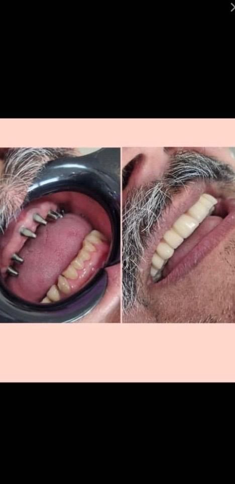 دندانپزشکی ستارخان اقساط ایمپلنت کامپوزیت عصبکشی|خدمات آرایشگری و زیبایی|تهران, صادقیه|دیوار