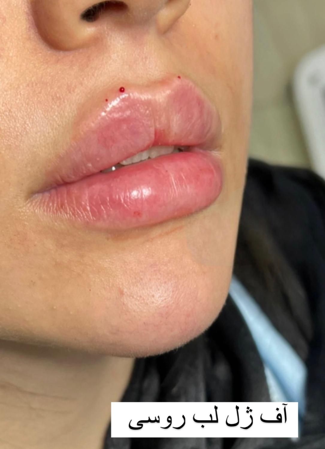 جشنواره پی آرپی ژل و بوتاکس مزوتراپی بلفارو|خدمات آرایشگری و زیبایی|اهواز, کیانپارس |دیوار