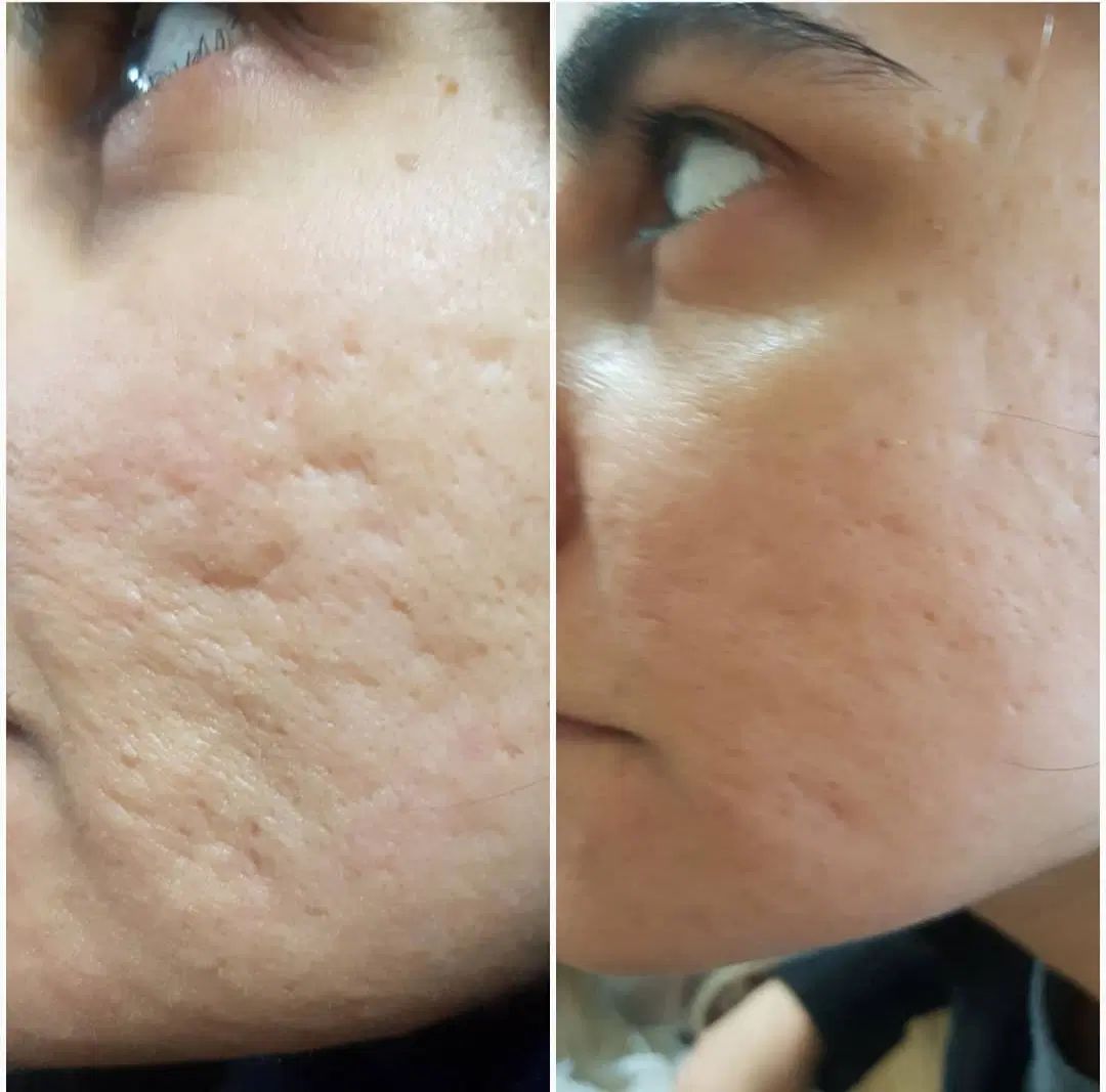 جوانسازی صورت با بهترین متریال و بروز ترین دستگاه|خدمات آرایشگری و زیبایی|گرگان, |دیوار
