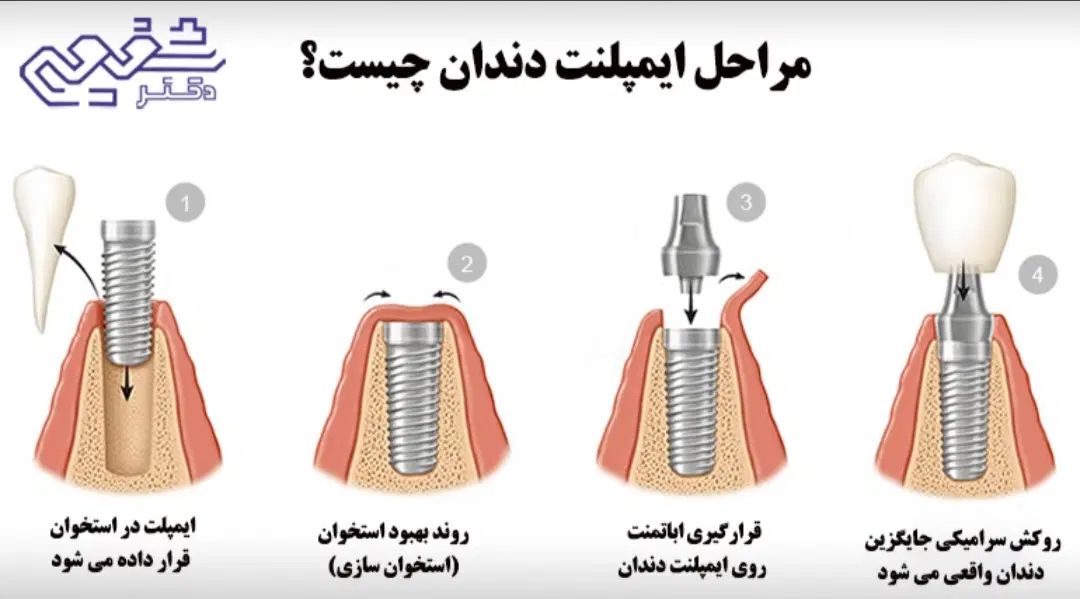 ایمپیلنت تخصصی کلینیک دندانپزشکی آرمی|خدمات آرایشگری و زیبایی|تهران, شکوفه (عبدل آباد)|دیوار