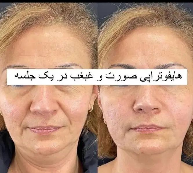 جشنواره لیفت/جوانسازی/انواع هایفو/در1جلسه فقط ۸۹۰ت|خدمات آرایشگری و زیبایی|اصفهان, ناژوان|دیوار