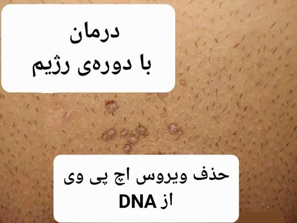 درمان زگیل تناسلی با یک دوره رژیم /|خدمات آرایشگری و زیبایی|مشهد, فارغ التحصیلان|دیوار